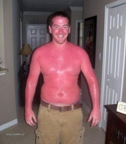 Thats Some Serious Sunburn