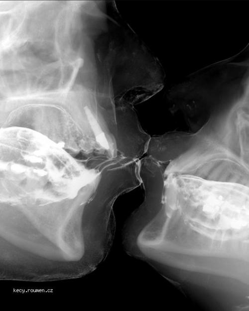  x ray kiss 