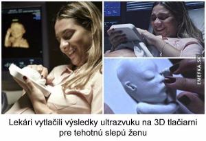 3D ultrazvuk