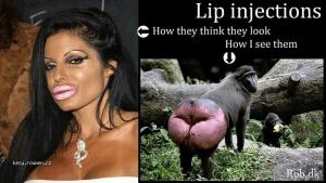 X Lip injections