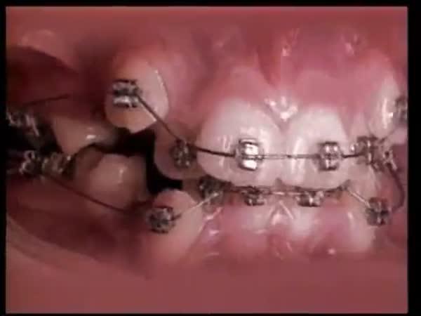 Timelapse - Narovnávání zubů rovnátky
