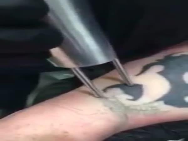 Jak se laserem odstraňuje tetování